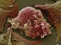 Раковые клетки легких