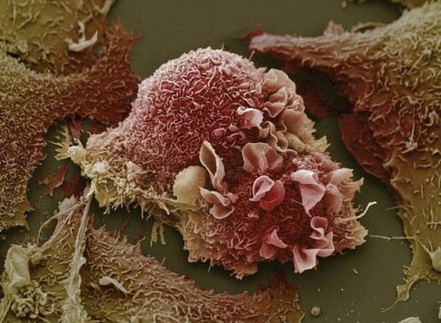 Раковые клетки легких